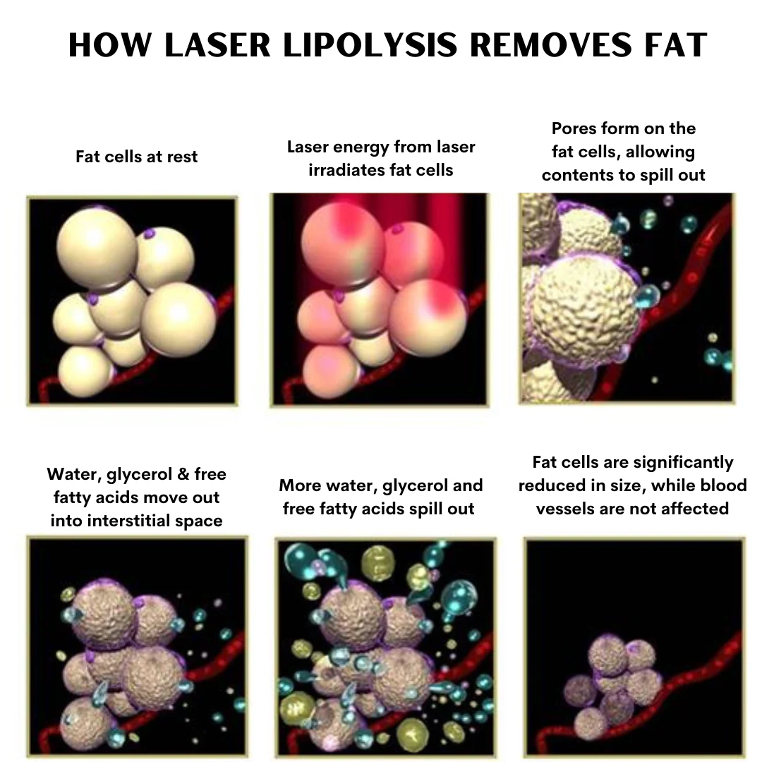 Elora 12D Diode Lipo Laser Weight Loss Machine - Image 4