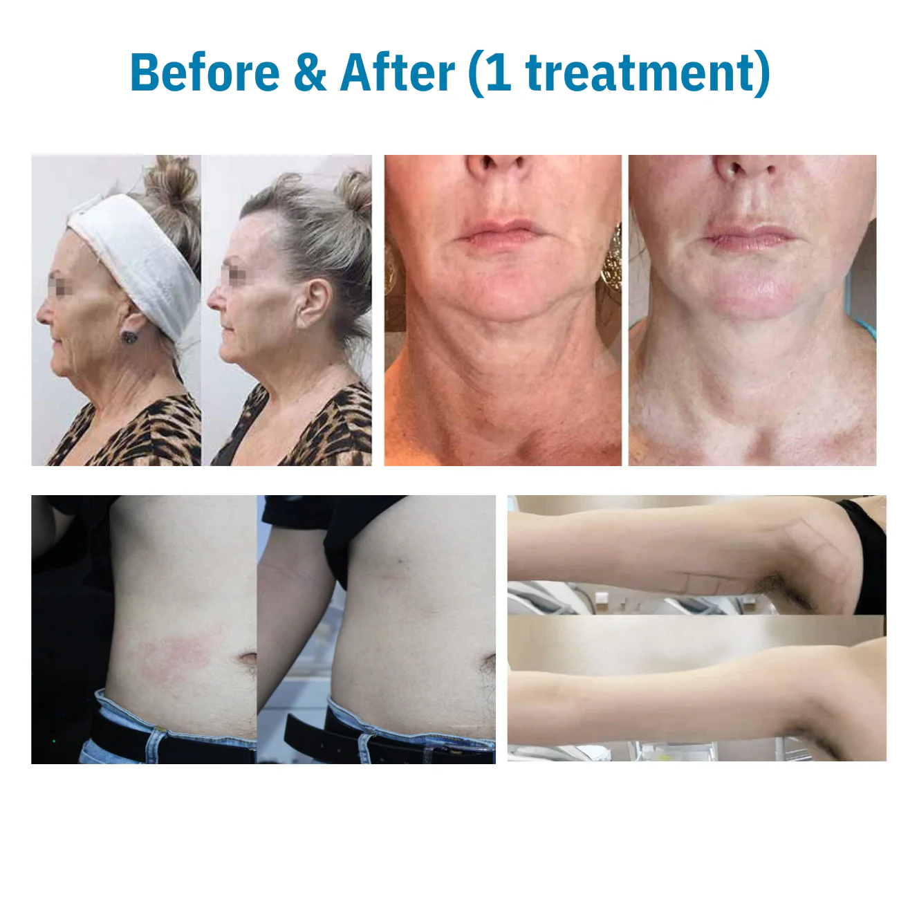 Rejuva 360 Ultra Formation Professional HIFU Machine (Body & Face) - II - Image 27