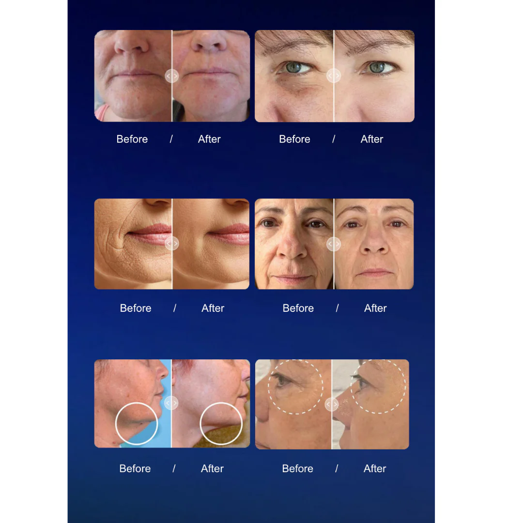 Rejuva 360 Ultra Formation Professional HIFU Machine (Body & Face) - II - Image 5