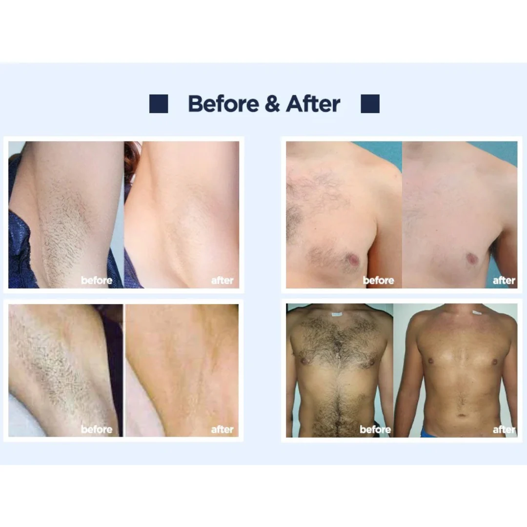 Athena 4D Laser Hair Removal Machine - Image 4