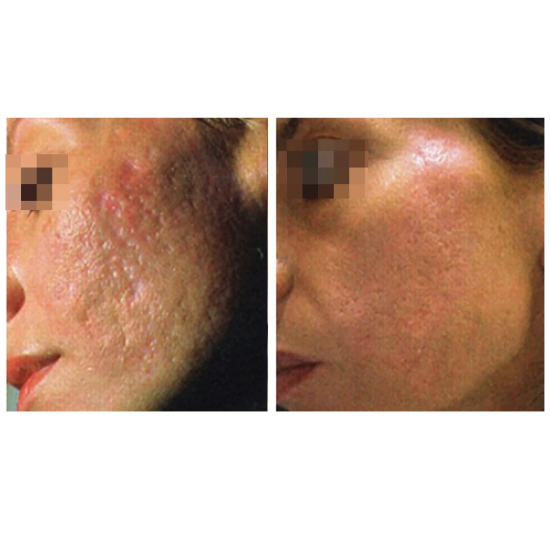 CoolPare™ EXPERT Fractional CO2 Laser - Image 3