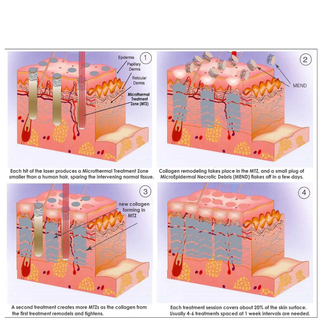 CoolPare™ EXPERT Fractional CO2 Laser - Image 5