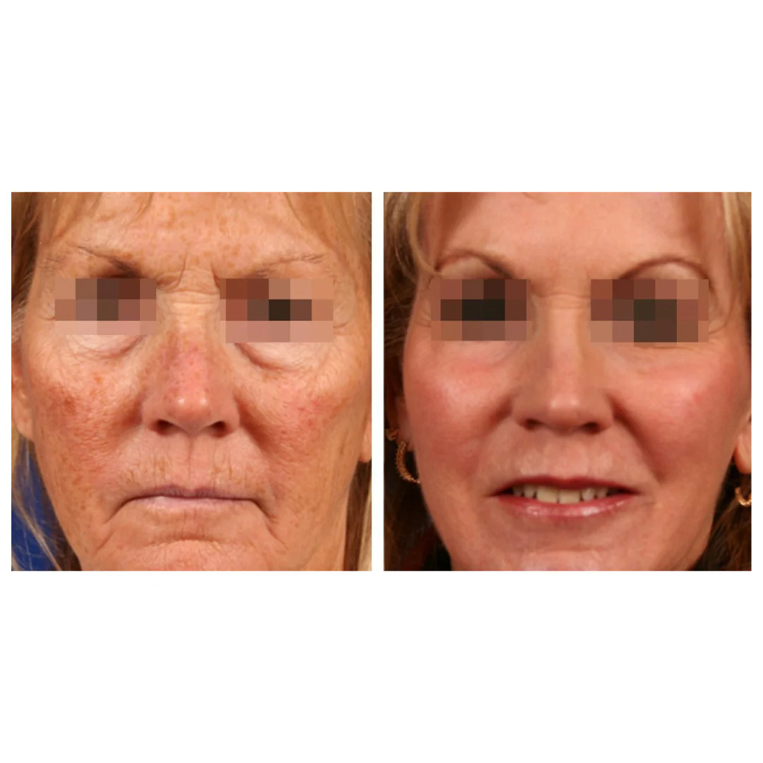 CoolPare™ EXPERT Fractional CO2 Laser - Image 6