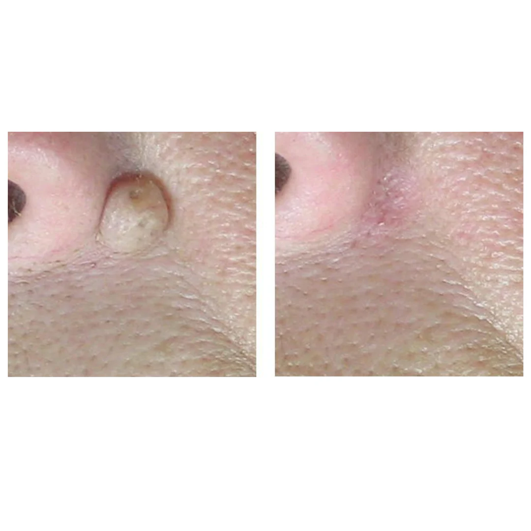 CoolPare™ EXPERT Fractional CO2 Laser - Image 7