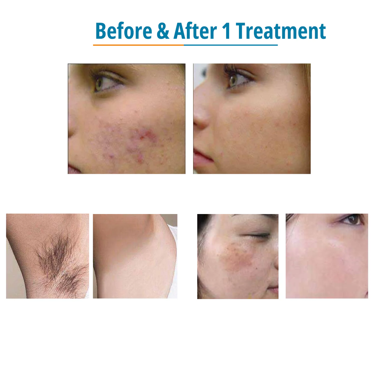 DermaLaze™ Delicate Spectrum Pulsed Light System - Image 4