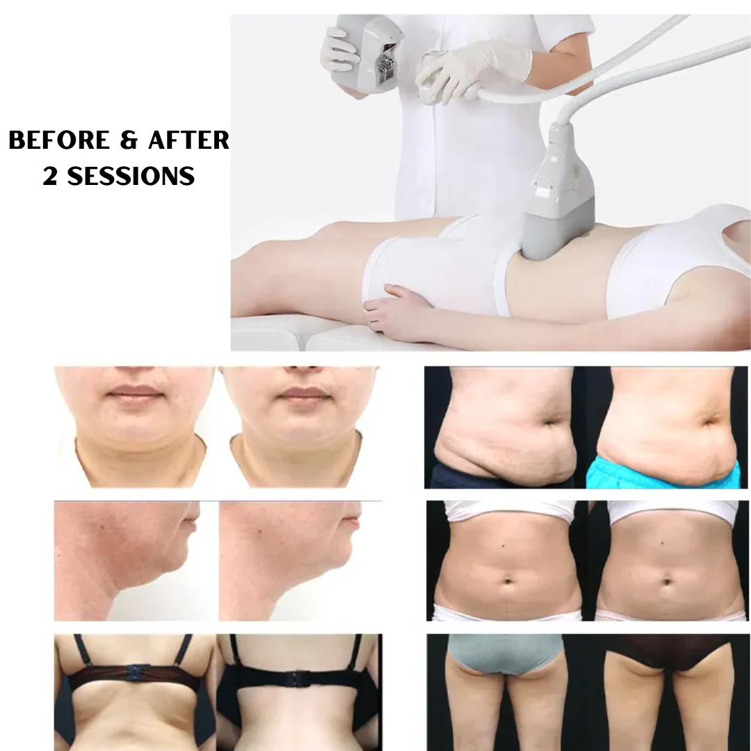 Diamond Ice Fat Removal Machine with 6 Medical Grade Applicators - Image 8
