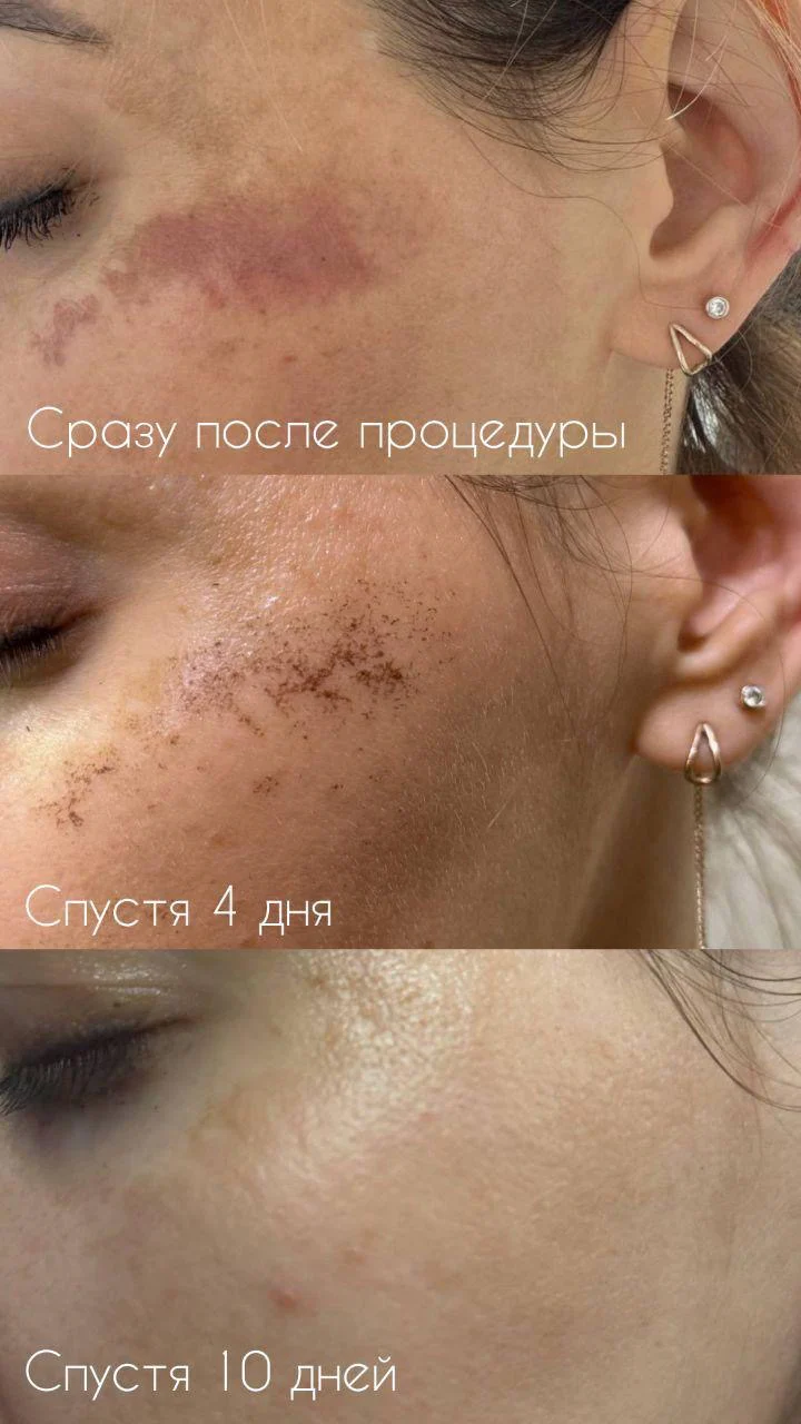 DuoSmooth 2-in-1 Diode Laser + IPL System - Image 12