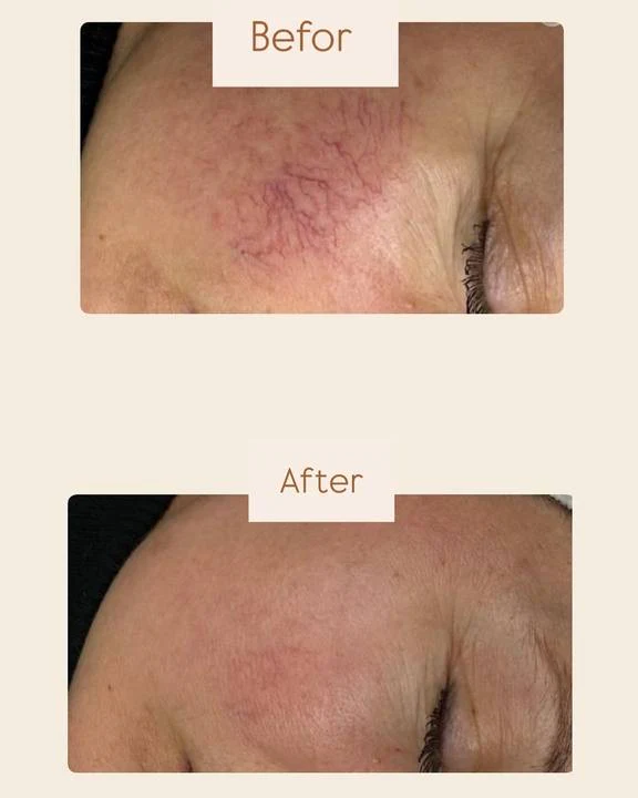 DuoSmooth 2-in-1 Diode Laser + IPL System - Image 14