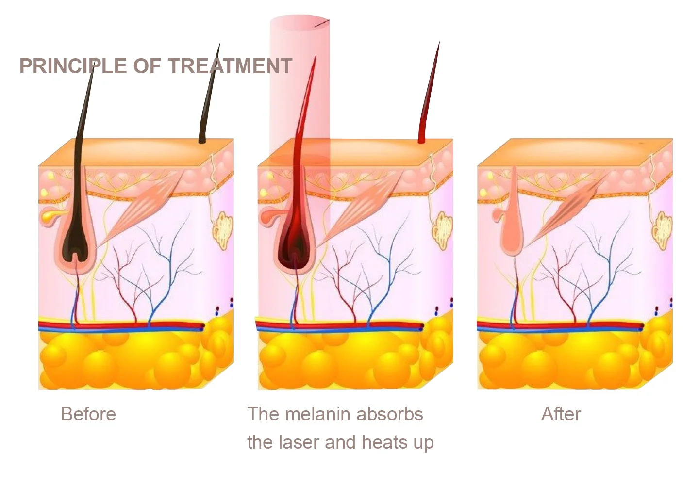 DiolaSheer™ Ice Hair Removal Laser Machine (4 Wavelengths) - Image 9