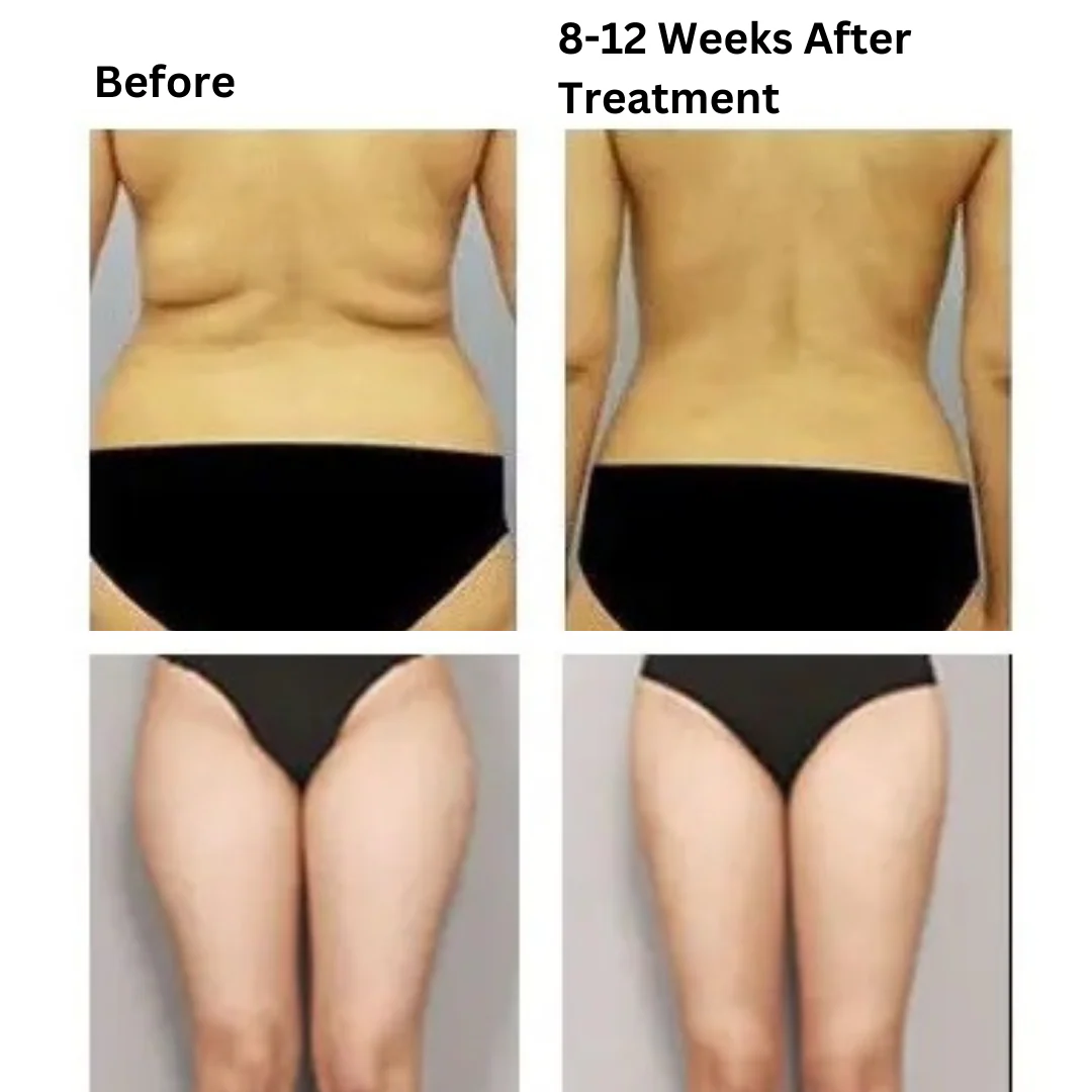 LipoSonic Portable Weight Loss HIFU Machine - Image 4