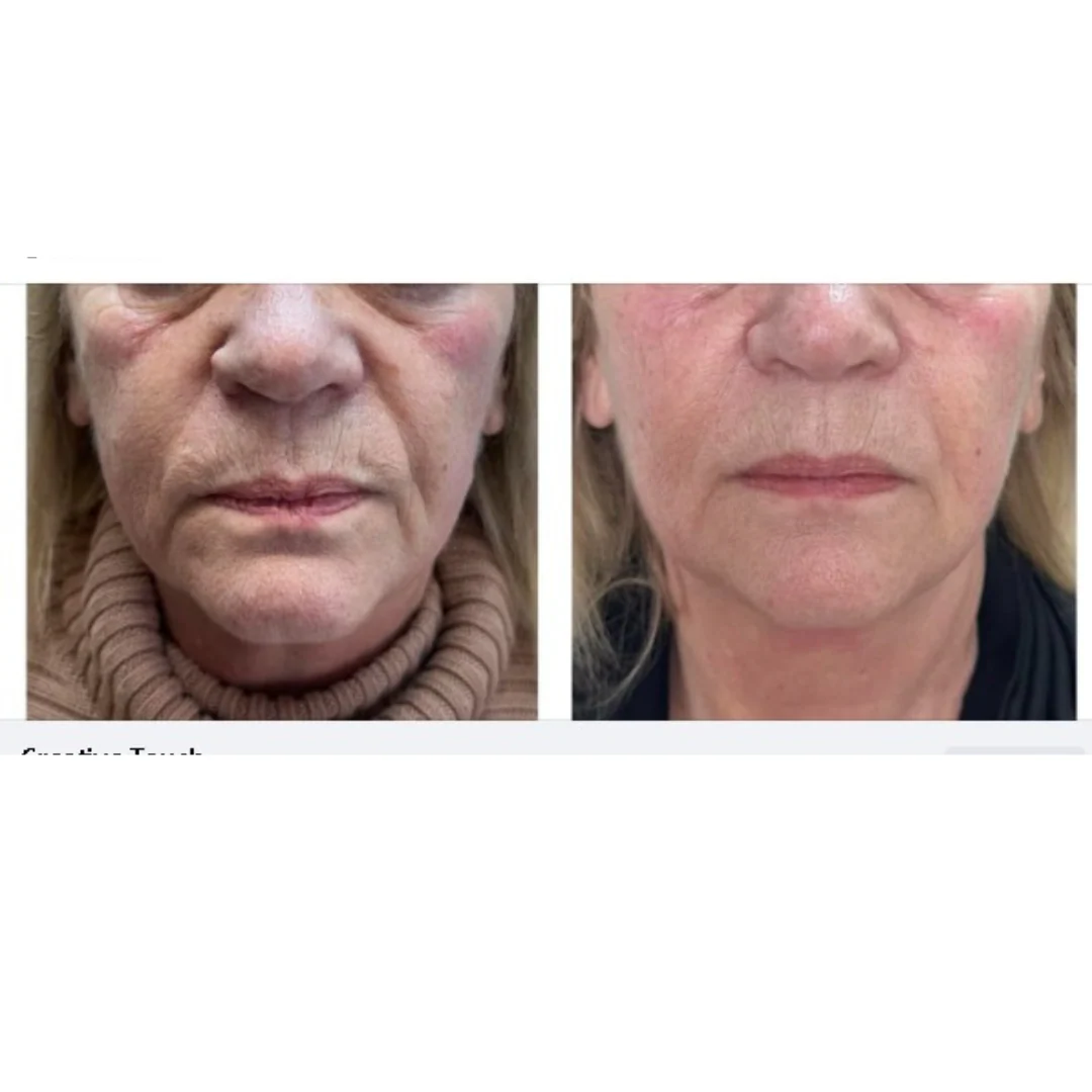 Personal PERFECT FACE NEO - 3D Facial Therapy Machine - Image 5