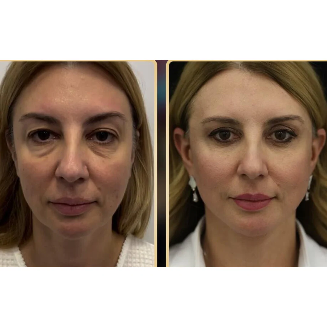 Professional PERFECT FACE™ NEO Skin Ultra 7D - Image 16