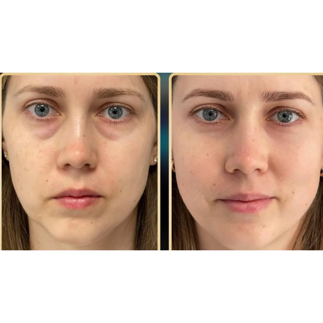 Professional PERFECT FACE™ NEO Skin Ultra 7D - Image 5