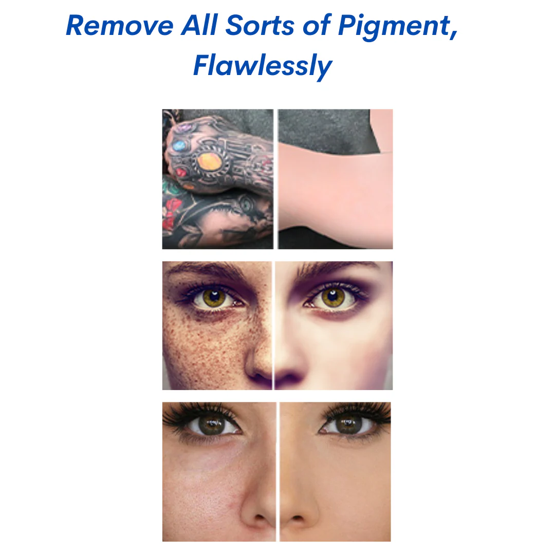 PicoErase® Tattoo Removal Laser Machine - Image 3