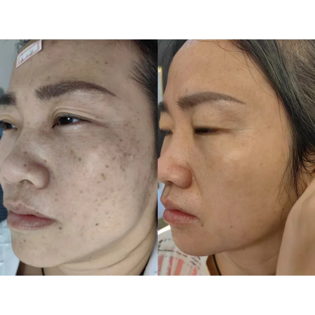 PicoElim Tattoo Removal Laser Spot Master - Image 10