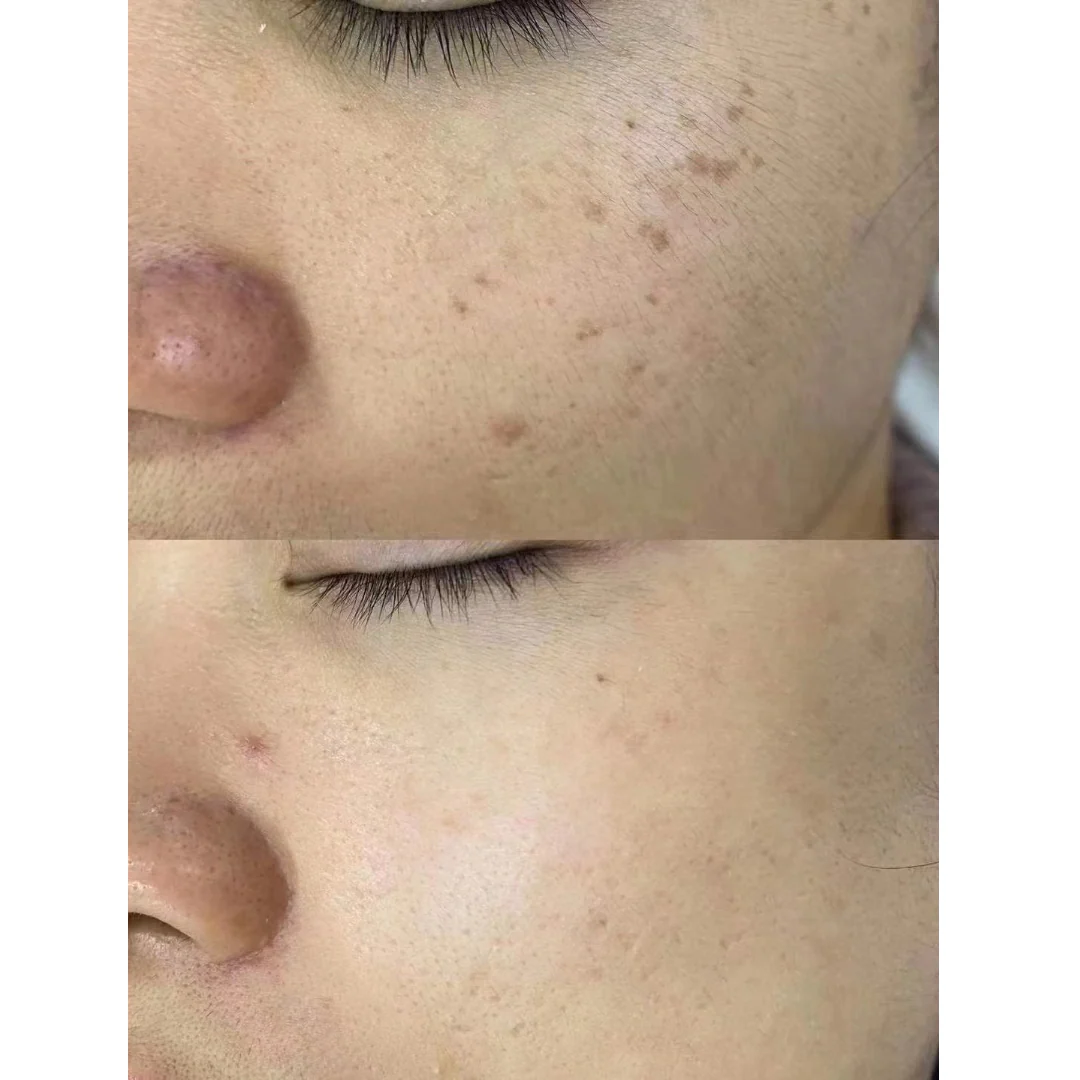 PicoElim Tattoo Removal Laser Spot Master - Image 9