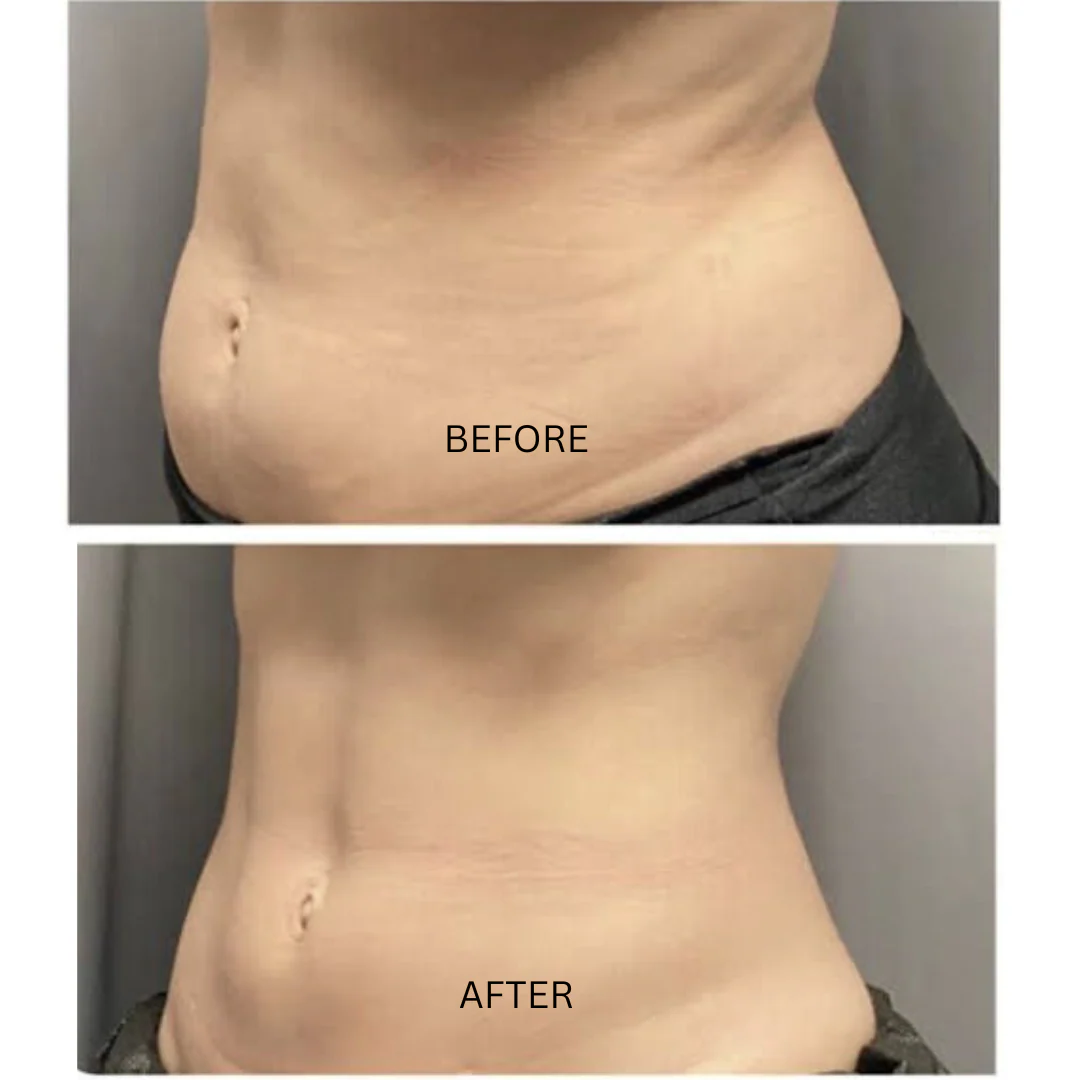 Professional PERFECT SHAPE® NEO PLUS (Body & Face) - Image 11