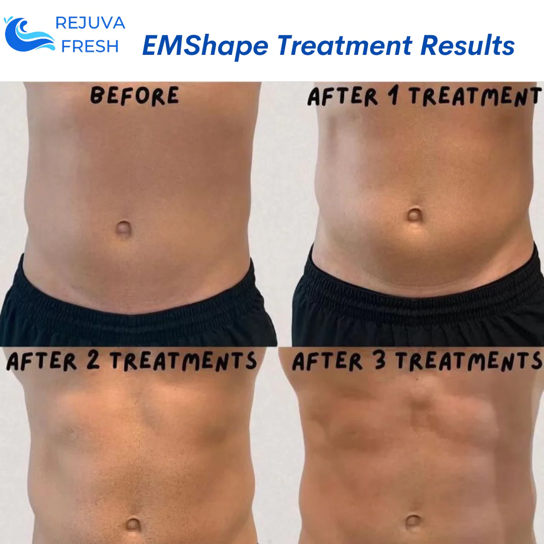 EMShape® Neo Android Body Contouring Machine - Image 2