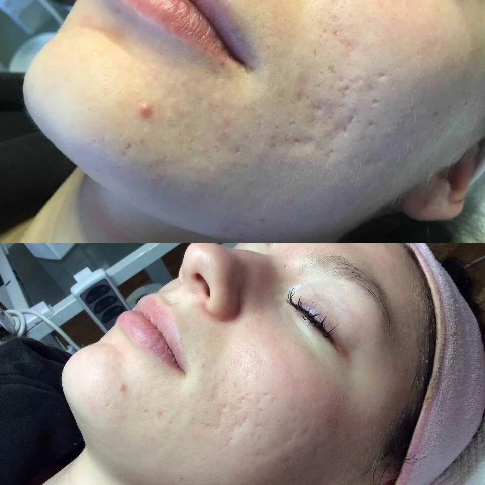 Reveal™ PRO SuperPulse CO2 Laser (80W, Digital) - Image 19