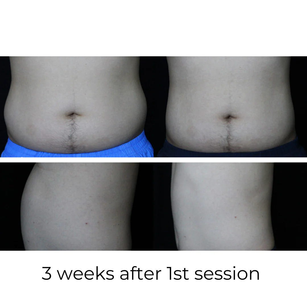 SculptAssure 1060nm Diode Laser Weight Loss Machine - Image 4