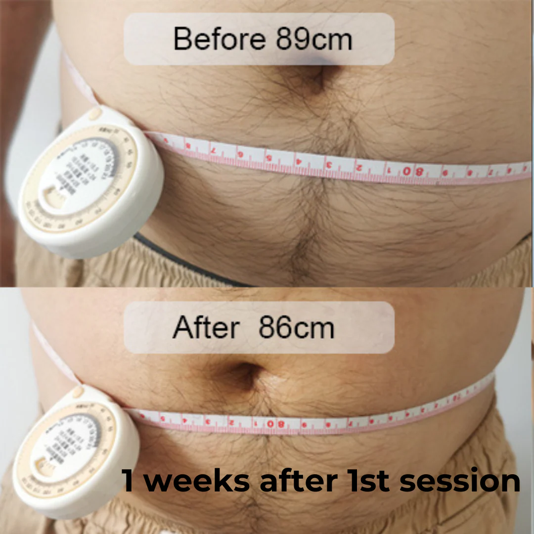 SculptAssure 1060nm Diode Laser Weight Loss Machine - Image 5