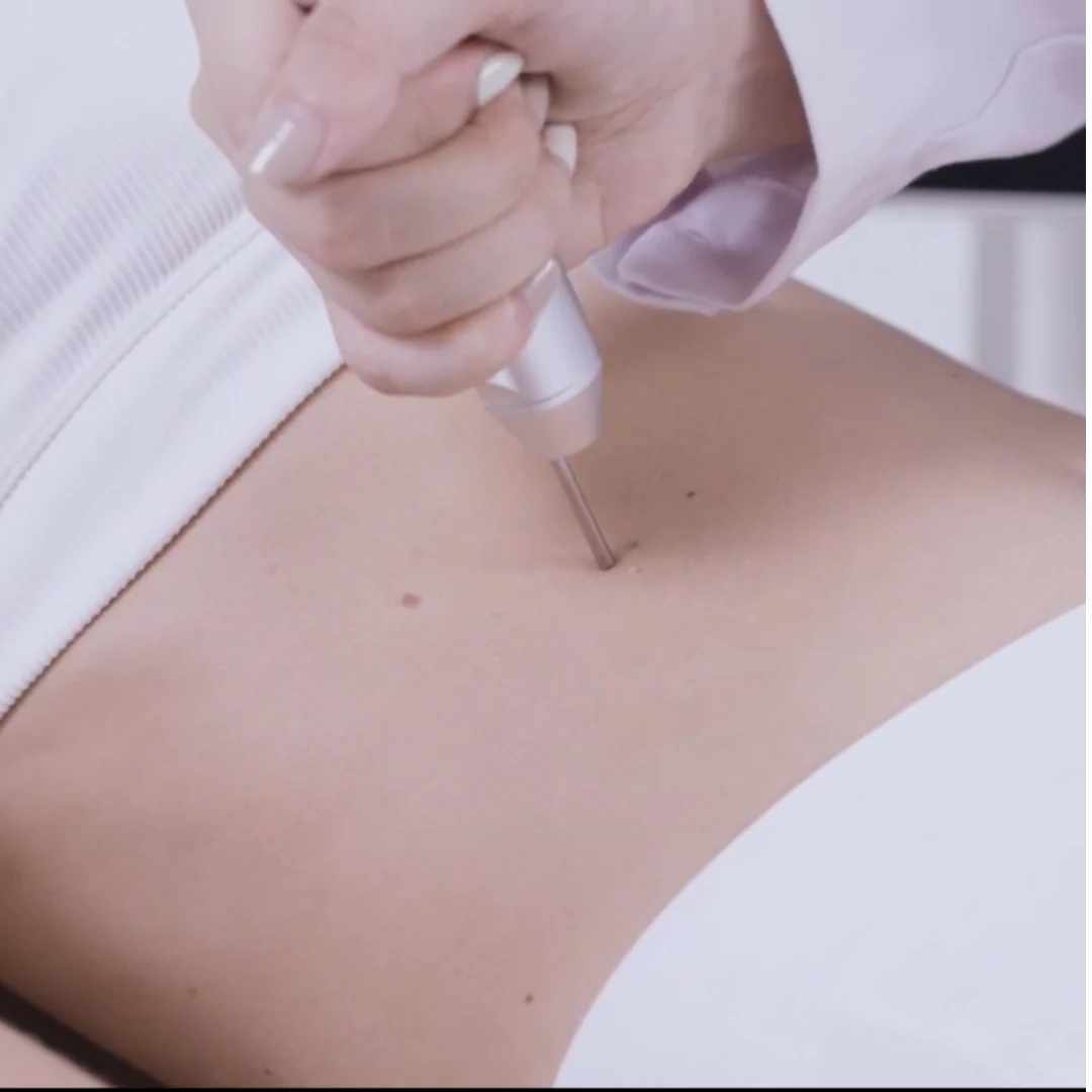 CarbonFrax™  Pro CO2 Fractional Laser - Image 7
