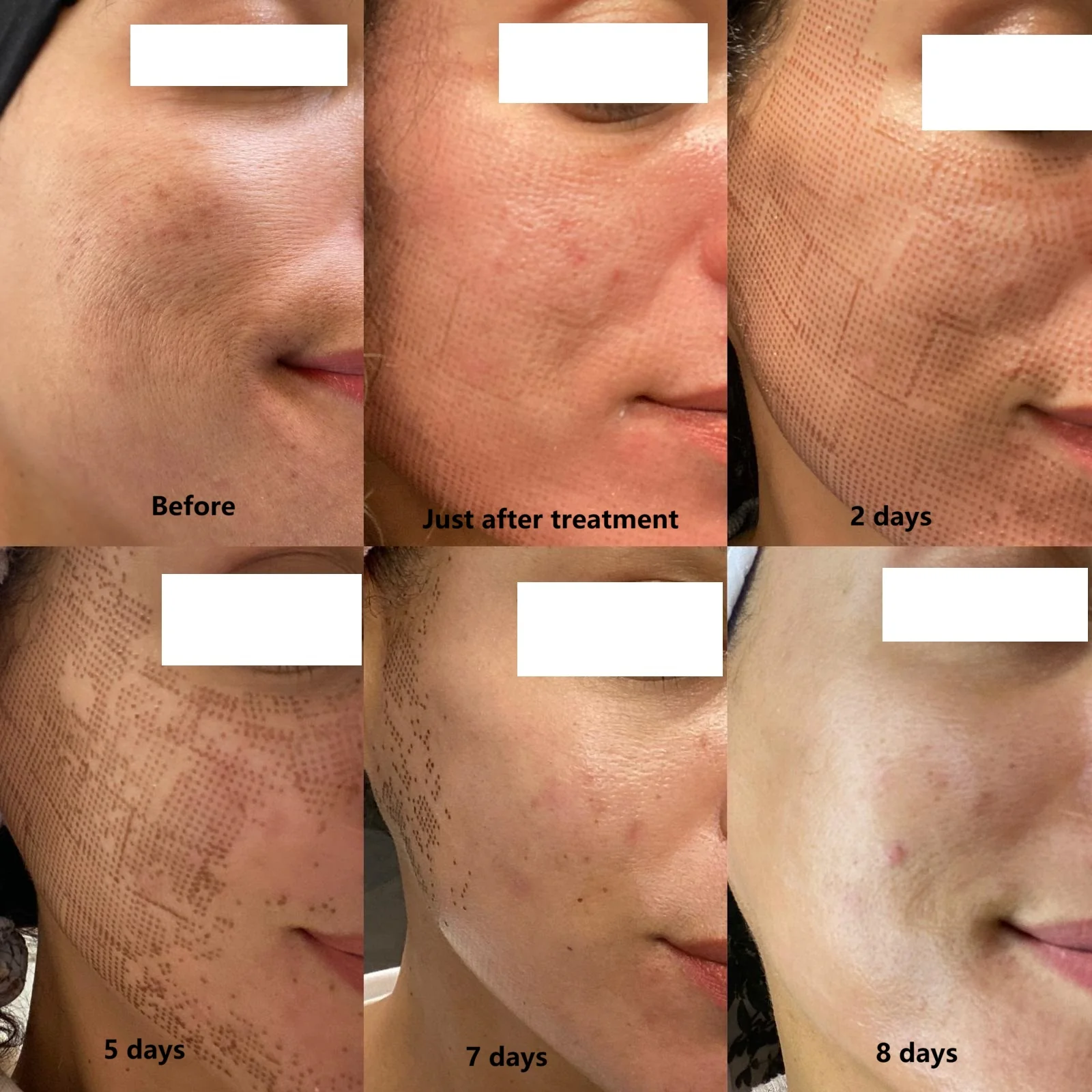 CarbonFrax™  Pro CO2 Fractional Laser - Image 13