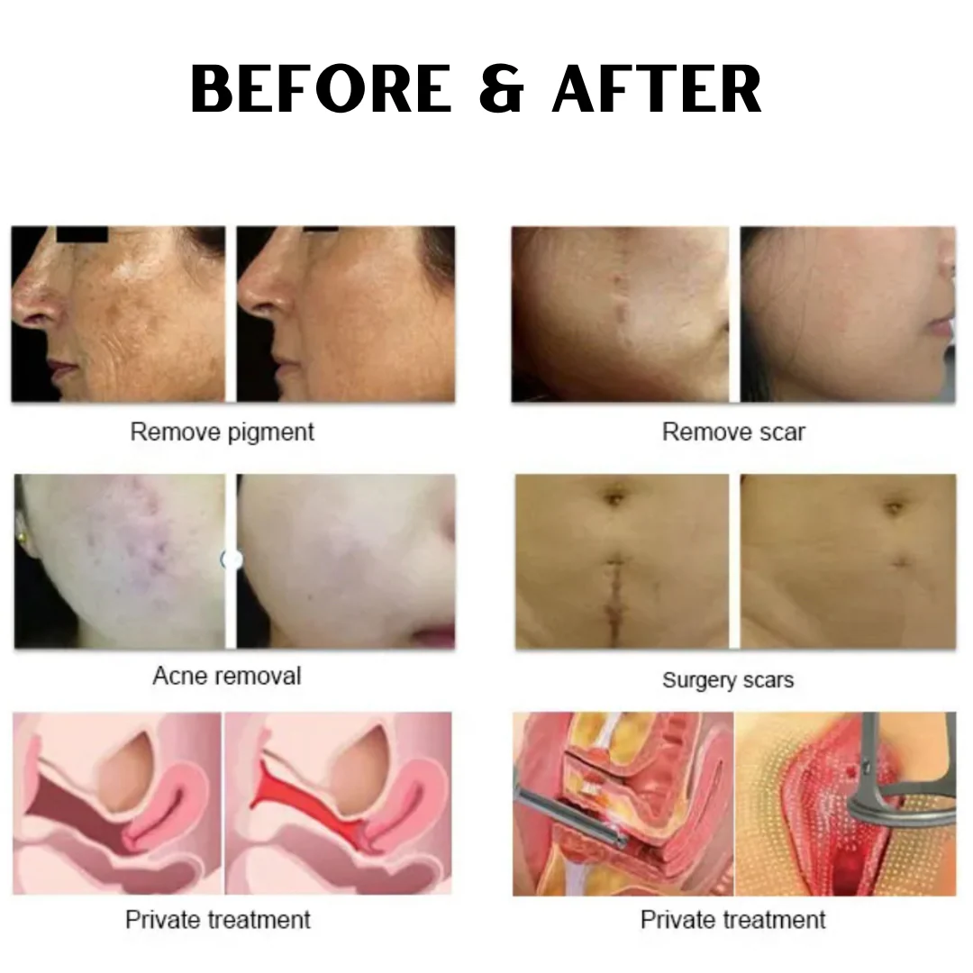 CarbonFrax™  Pro CO2 Fractional Laser - Image 3