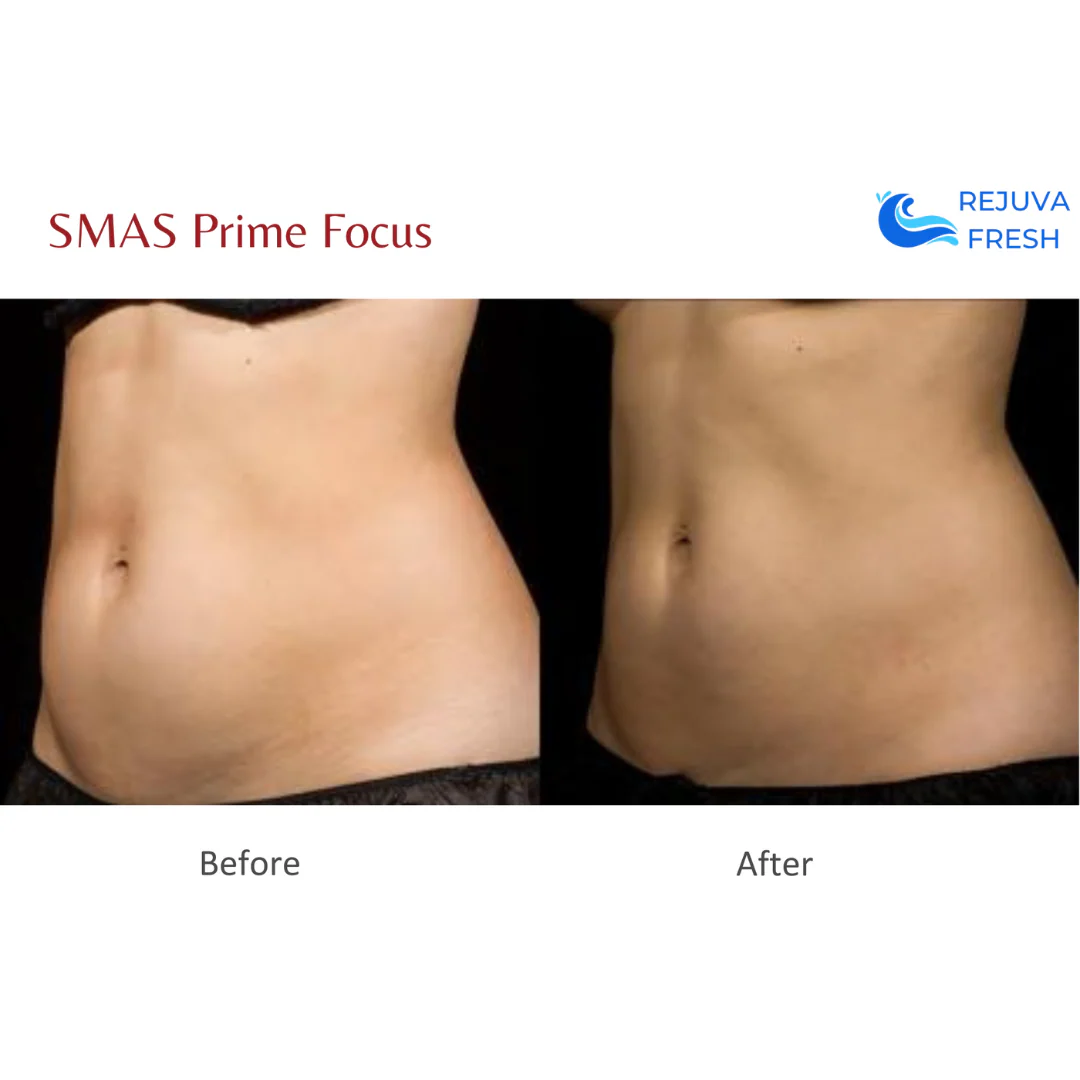 SMAS Prime Focus Professional HIFU Machine for Body & Face - Image 4