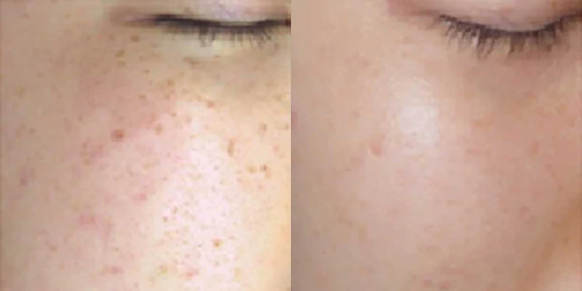 Optimal Skin Resurfacing Power Trio - Image 12