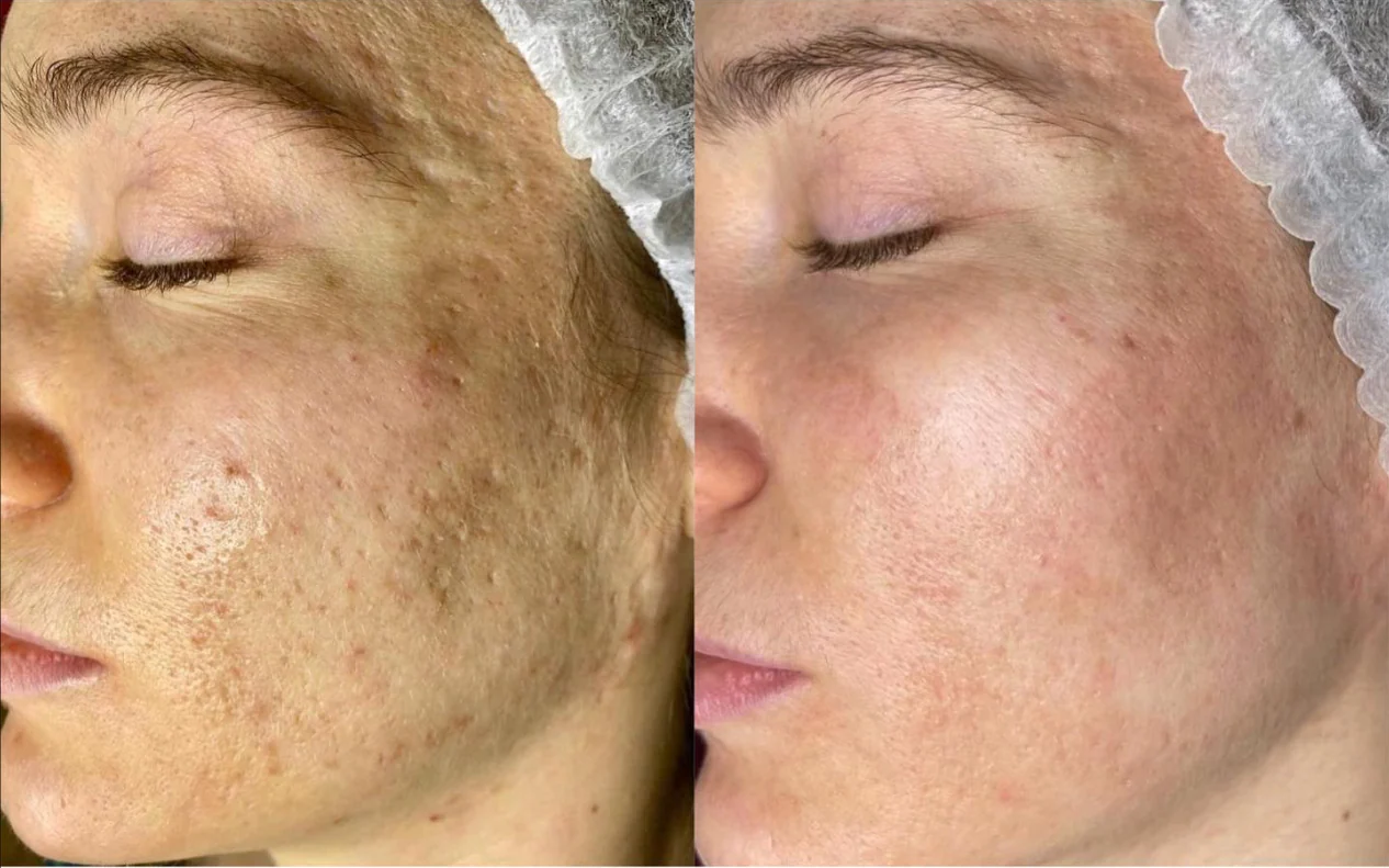 Optimal Skin Resurfacing Power Trio - Image 4